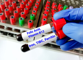 Scientist holding blood samples for Iron, TIBC, Ferritin and Folic acid, Vitamin B12 test to...
