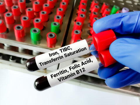 Scientist holding blood samples for Iron, TIBC, Ferritin and Folic acid, Vitamin B12 test to diagnose  iron deficiency anemia.
