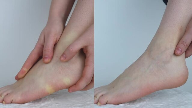 Before and after. Sole of the foot pain, tendon sprains, inflammation, flat feet, bursitis, fasciitis. Achilles tendon and heel pain. On left, she found an injury, on right, she had already been cured