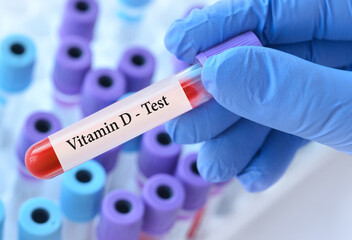 Doctor holding a test blood sample tube with Vitamin D test on the background of medical test tubes...