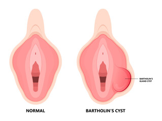 Bartholin’s cyst of vagina pain lump mass with E. coli bacteria sex safe pelvic exam cervix swollen pus lips vulva blockage - obrazy, fototapety, plakaty