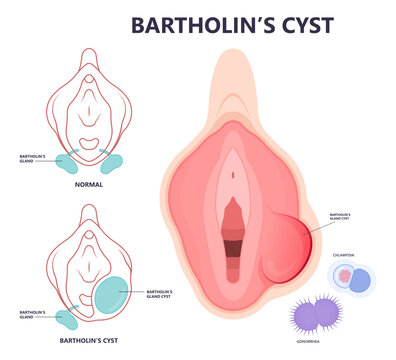 pelvic exam pain Bartholin’s cyst of vagina lump mass with E. coli bacteria sex safe cervix swollen pus lips vulva blockage