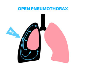 Pneumothorax anatomical poster