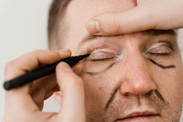 Male blepharoplasty for man markup. Plastic surgeon draws markings on the eyelid before plastic...