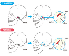 正常な顎関節と顎関節症の比較 - obrazy, fototapety, plakaty
