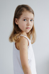 Portrait of child with pimples of chickenpox