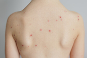 Close-up of naked back of child with pimples of chickenpox