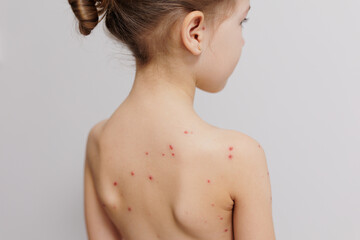 Close-up of naked back of little child with pimples of chickenpox - obrazy, fototapety, plakaty