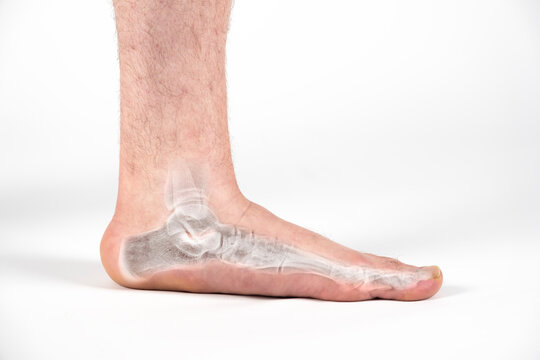 Close up of mans bare foot with strong flat feet also called pes planus or fallen arches.