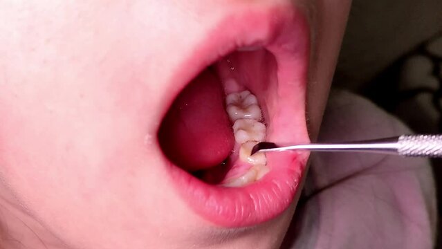 Pediatric dentist examines a loose milk tooth in a child