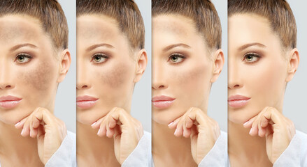 Dark spots, freckles,hyperpigmentation(melasma or chloasma),concept - skin lightening, skin...