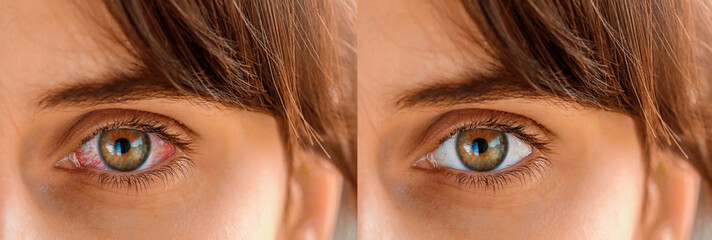 Red eye before and after treatment. Tired eyes and contact lenses. Close up. Dry eye before and after the use of eye drop.