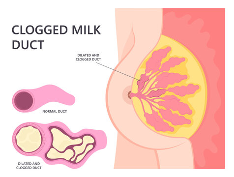 Skin lymph nodes pus abscess mastitis swelling breast gland engorgement cyst cancer Pregnancy lump baby newborn pump care sore tumor lactational pain