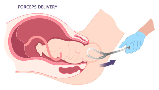 Forceps Assisted Childbirth Delivery Vacuum Vaginal Cesarean C Section the procedure in medical labor to pull baby from uterus fetal and scalp edema occiput anterior pain facial palsy