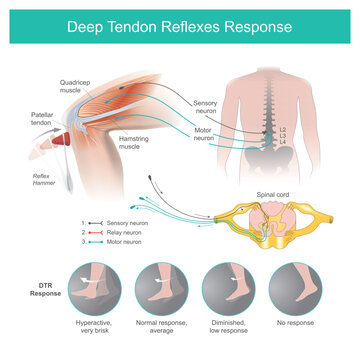 Deep Tendon Reflexes Response. The doctor testing nervous systems by a Reflex Hammer using knocking on the tendon in the knee area causing the shin to move automatically..