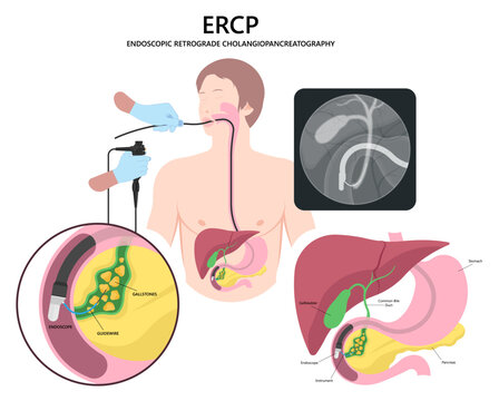 Endoscopic Retrograde Cholangiopancreatography gallbladder Cholangitis Gallstones Choledocholithiasis or ERCP Common stone bile duct removal cancer infection cholecystitis tract pancreatitis surgery