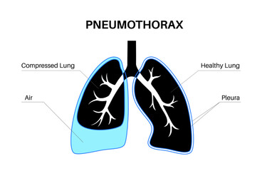 Pneumothorax anatomical poster