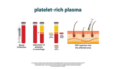 Platelet-Rich plasma procedure stages / prp / Centrifuge vector