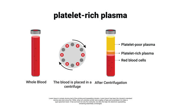 Platelet-Rich plasma procedure stages / prp / Centrifuge vector