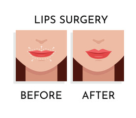 Lips Surgery correction Vector illustration. Plastic and aesthetic surgery concept. Beauty Procedure  on woman Face with dotted lines on lips and anatomical zones Up and Down flat design cartoon style