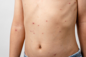 Fototapeta na wymiar A 7 year old Asian boy has chickenpox. pimples on the body of child with chickenpox