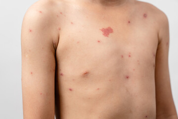 A 7 year old Asian boy has chickenpox. pimples on the body of child with chickenpox