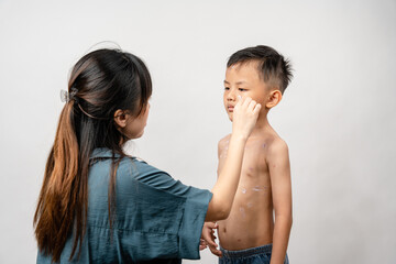 A mother is applying itching ointment to him 7 year old Asian boy suffering from chickenpox. pimples on the body of child with chickenpox