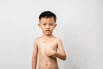 A 7 year old Asian boy has chickenpox. pimples on the body of child with chickenpox