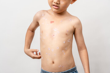 A 7 year old Asian boy has chickenpox. pimples on the body of child with chickenpox