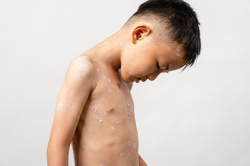 A 7 year old Asian boy has chickenpox. pimples on the body of child with chickenpox