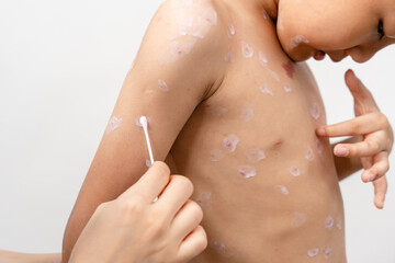 A 7 year old Asian boy has chickenpox. pimples on the body of child with chickenpox
