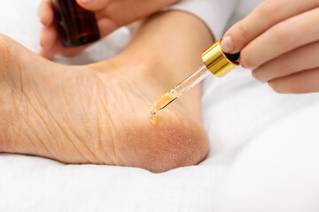 Close-up of womans hand applies moisturizing oil to the heels of feet with dry cracked skin while sitting on a white bed. Foot care and treatment for dermatitis, eczema, psoriasis and peeling concept.