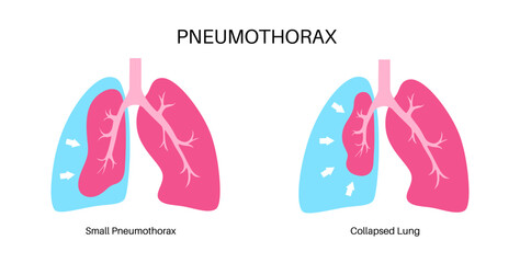 Pneumothorax anatomical poster