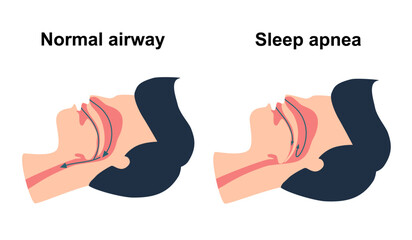 Obstructive sleep apnea syndrome concept vector illustration. - obrazy, fototapety, plakaty