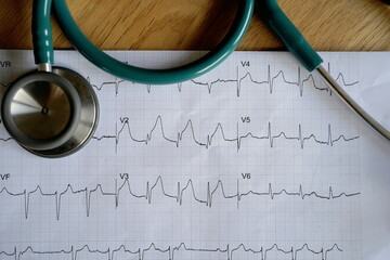 stethoscope on a real emergency ECG with a occlusive anterior myocardial infarction (STEMI)