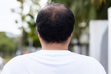 Middle aged asian man with early stage baldness and hair loss problem - obrazy, fototapety, plakaty