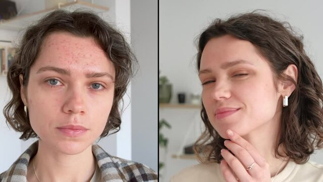 Two close up faces of young caucasian woman show real result before and after acne treatment. Split screen. Home background. Concept  of acne therapy, scars, inflammation on face and problem skin