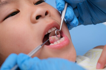 Close-up in the oral cavity of a healthy child with beautiful white teeth. Young girl opens her mouth to reveal healthy teeth, hard and soft palate. Dental and oral health check