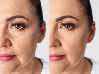 Woman looking better due to cosmetic procedures, closeup. Collage with photos on white background...
