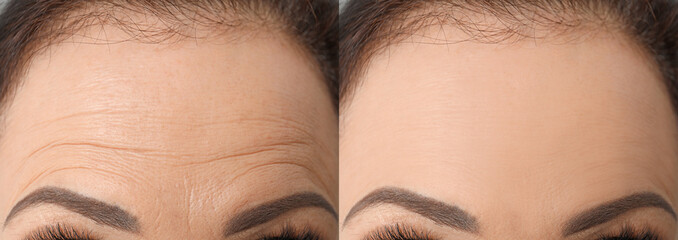 Woman before and after rejuvenating procedures. Collage with photos, closeup