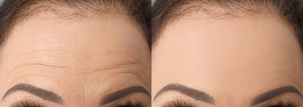 Woman before and after rejuvenating procedures. Collage with photos, closeup