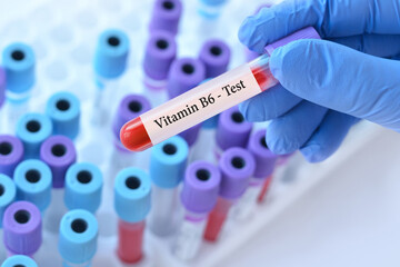 Naklejka premium Doctor holding a test blood sample tube with Vitamin B6 test on the background of medical test tubes with analyzes.Banner.