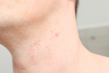 Skin irritation on male neck after shaving. Close-up photo. - obrazy, fototapety, plakaty