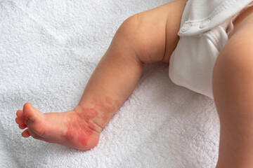 Hemangioma red birthmark on the leg of newborn baby