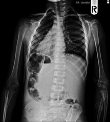 Film x-ray chest PA upright 