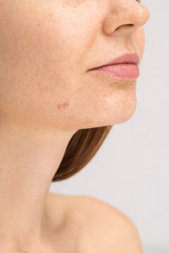 Acne Treatment Concept 
