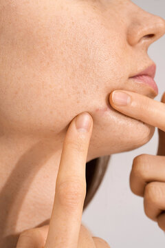 Acne problems skin 
