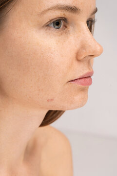 Acne problems skin concept 