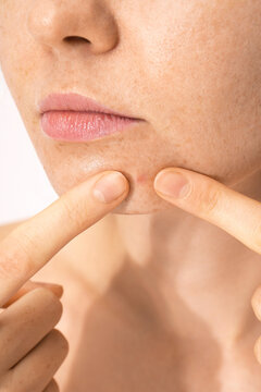 Acne problems skin 