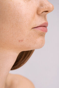 Acne Treatment Concept 